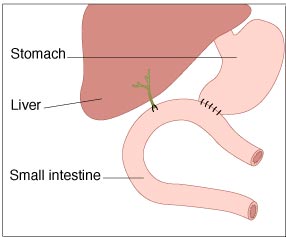 Total pancreatectomy after diagram